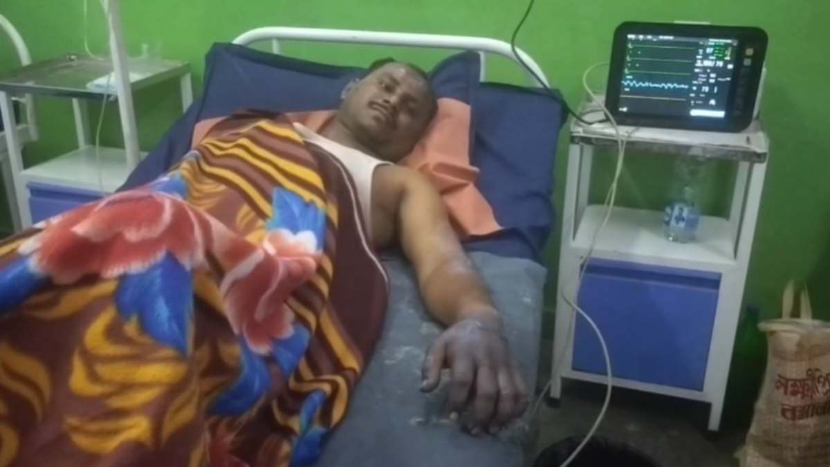स्टील फैक्ट्री में हादसा : भट्टी में काम करते समय बुरी तरह झुलसा श्रमिक, पुलिस को नहीं दी घटना की सूचना, प्रबंधन बोला- होते रहते हैं छोटे-मोटे हादसे