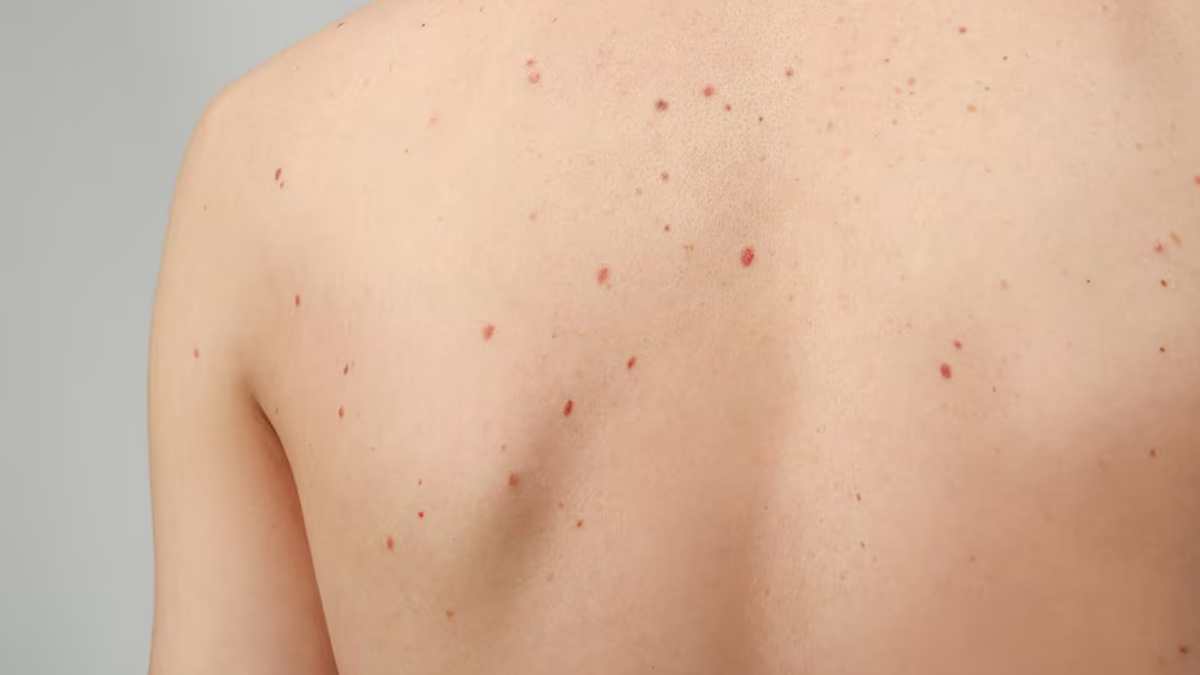 Body में क्यों नजर आने लगते हैं लाल तिल, जानिए इसके कारण और उपचार