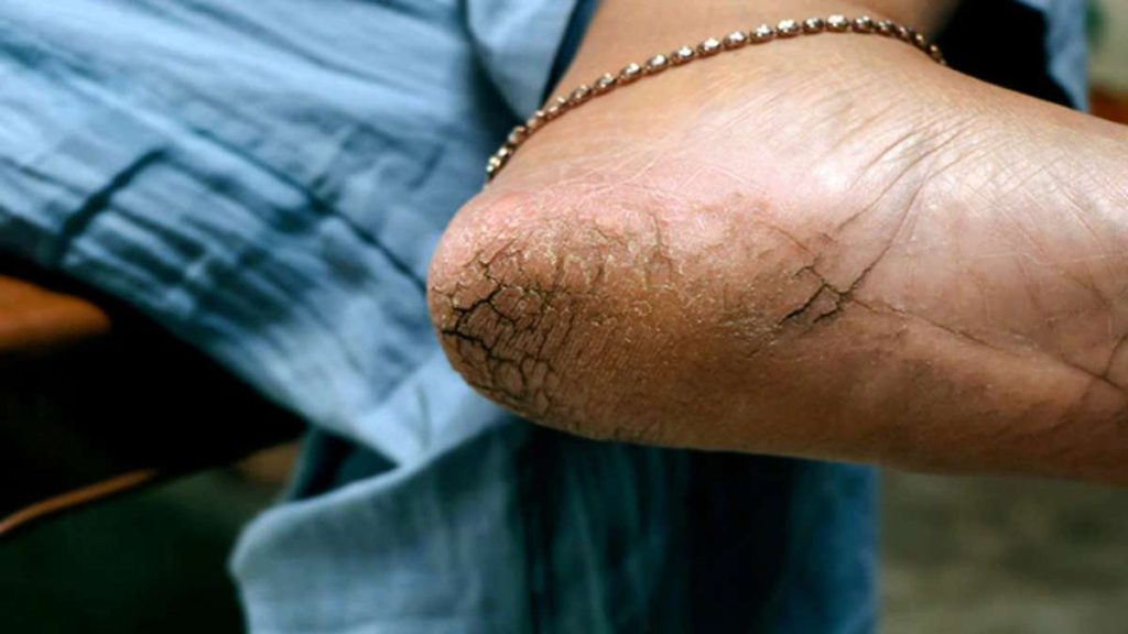 Home Remedies for Cracked Heels