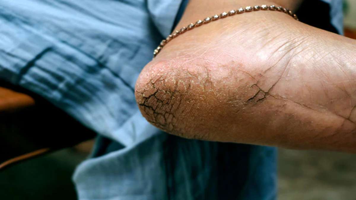 सर्दियों में फट रही हैं एड़ियां? अपनाएं ये 6 घरेलू नुस्खे, कुछ ही दिनों में मिल जाएगी राहत